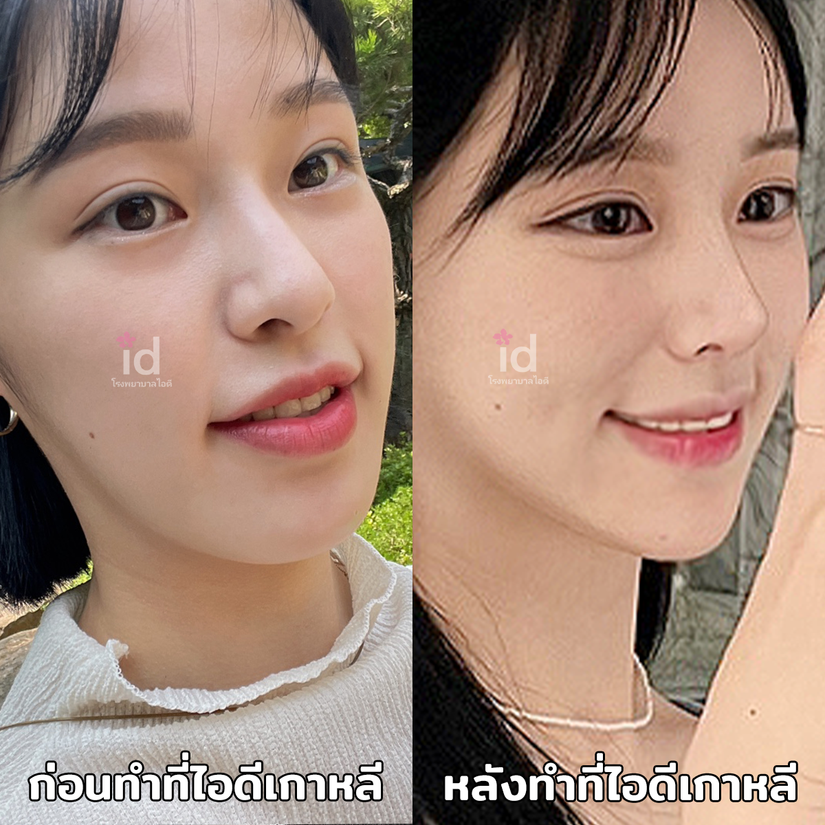 ภาพรีวิวก่อนและหลังศัลยกรรมโครงหน้า เคสที่ 18192