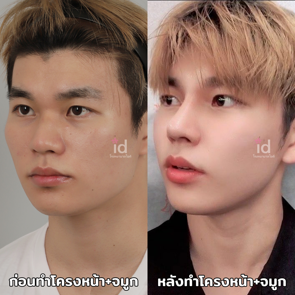 ภาพรีวิวก่อนและหลังศัลยกรรมโครงหน้า เคสที่ 18254