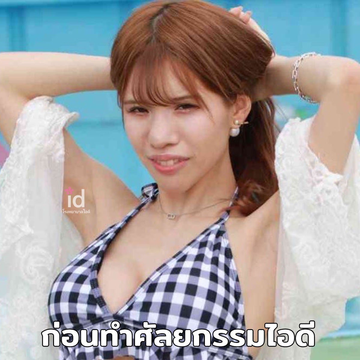 ภาพรีวิวก่อนและหลังศัลยกรรมโครงหน้า เคสที่ 18259
