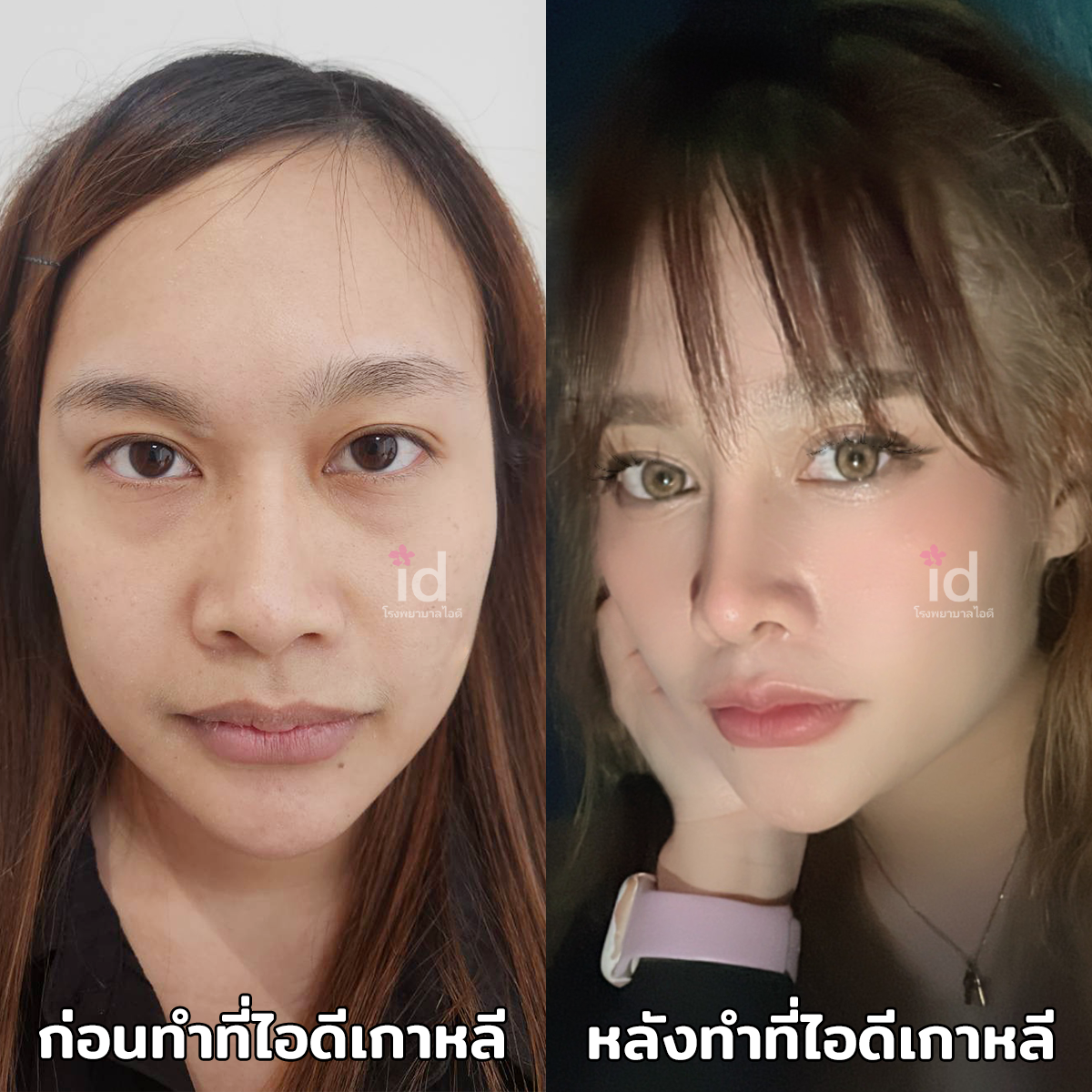 ภาพรีวิวก่อนและหลังจมูก เคสที่ 18247