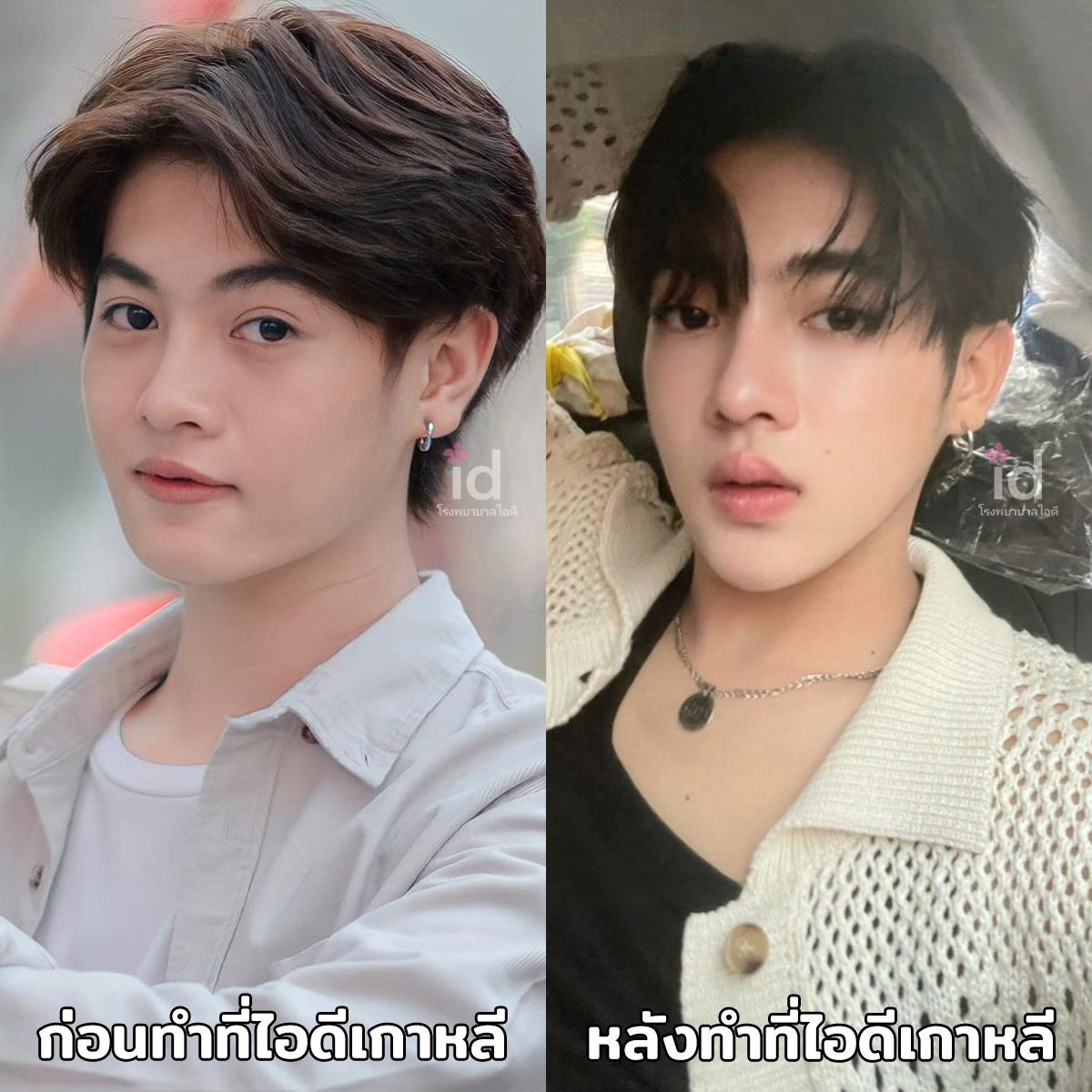 ภาพรีวิวก่อนและหลังศัลยกรรมโครงหน้า เคสที่ 18250