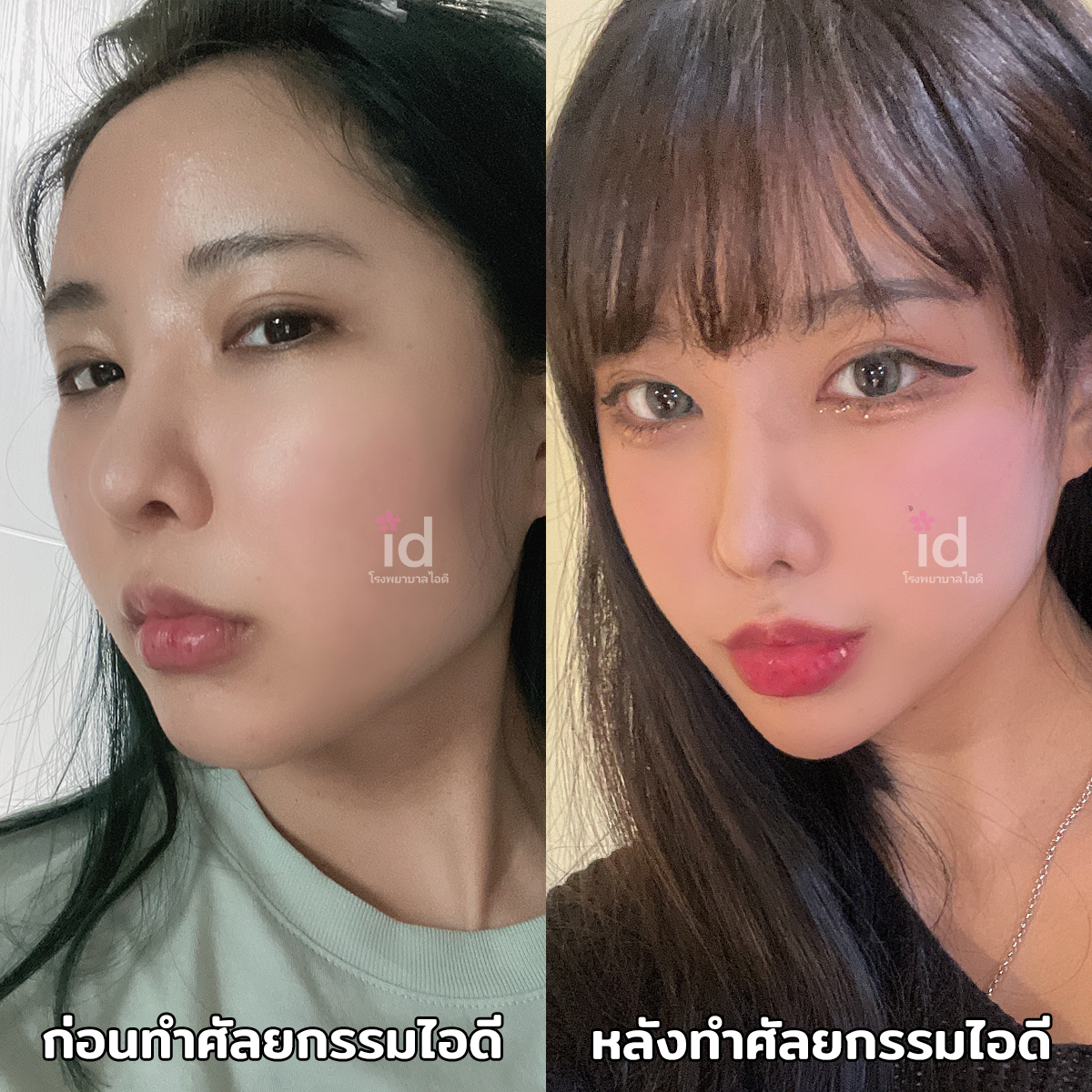 ภาพรีวิวก่อนและหลังศัลยกรรมโครงหน้า เคสที่ 18328