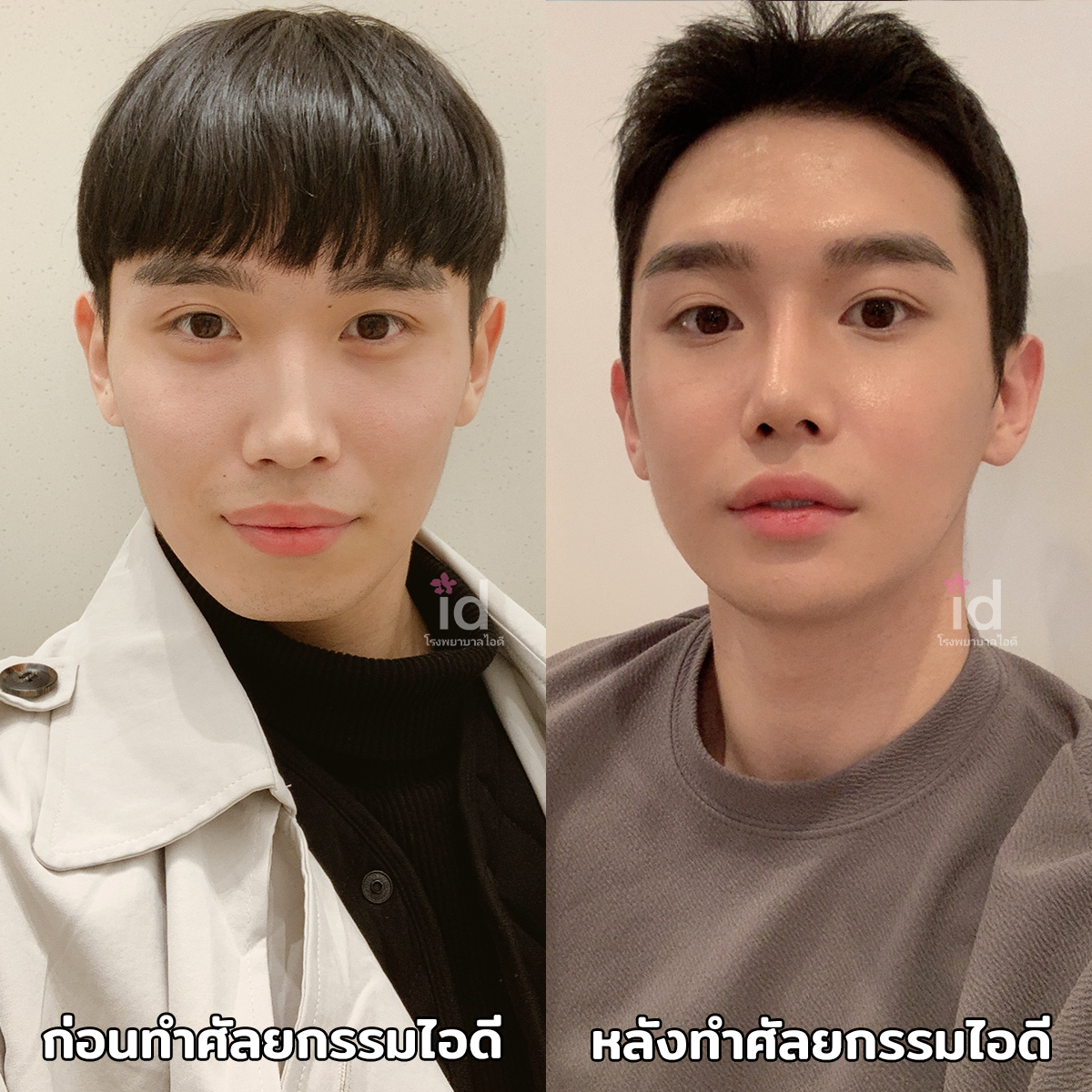 ภาพรีวิวก่อนและหลังศัลยกรรมโครงหน้า เคสที่ 18320