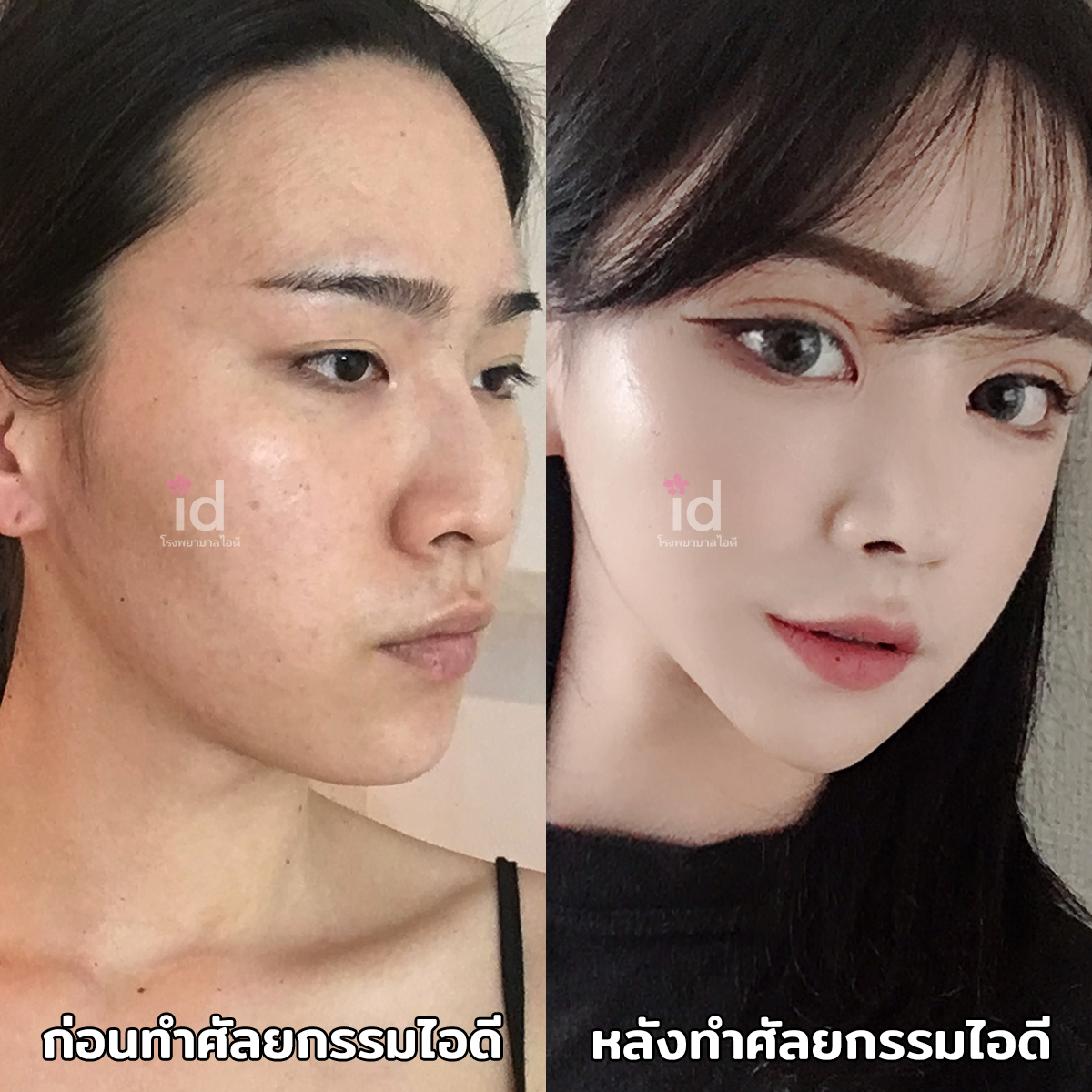 ภาพรีวิวก่อนและหลังขากรรไกร เคสที่ 18342