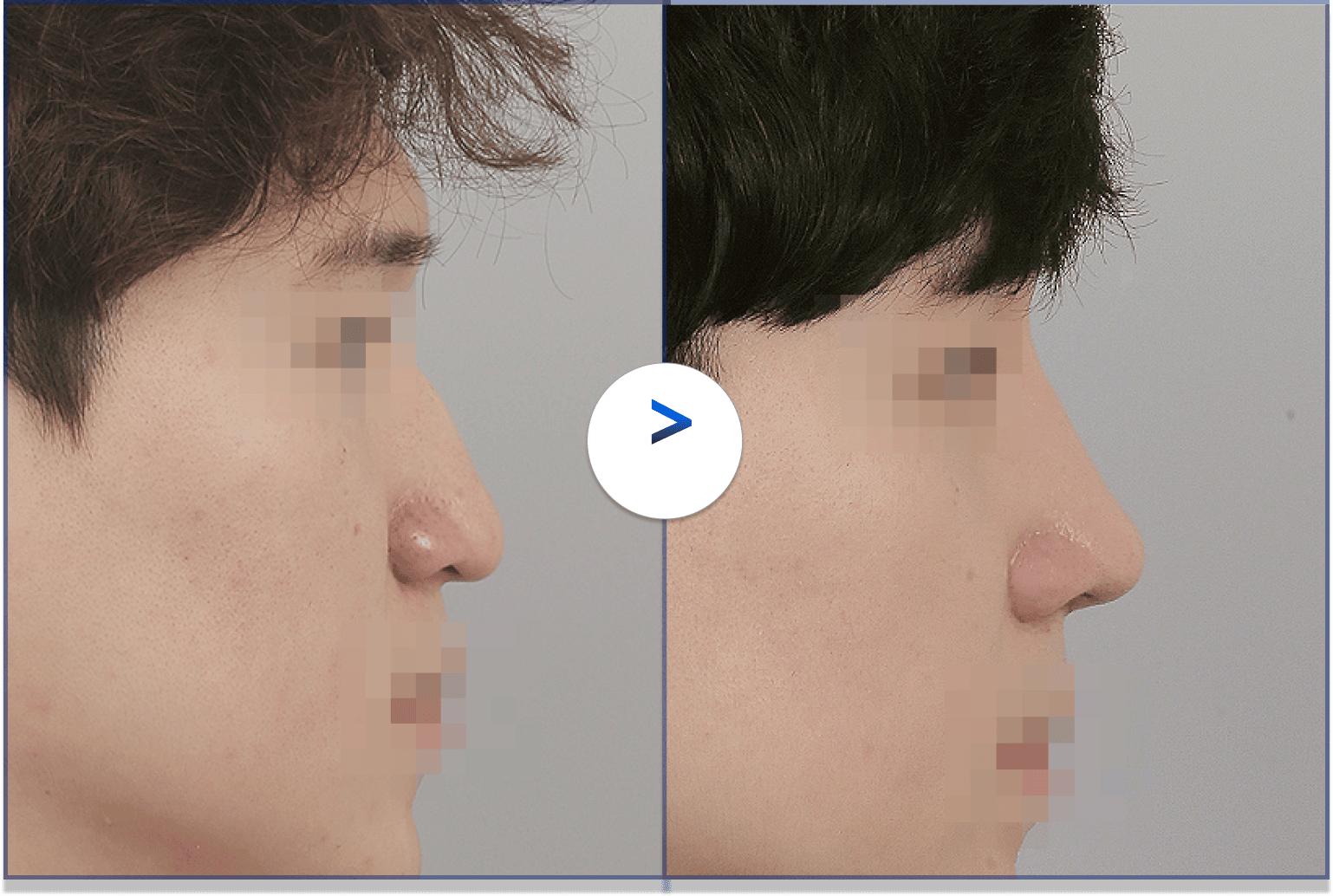 ก่อนและหลังเฉดดิ้งจมูก.
