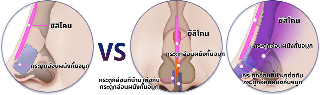 ศัลยกรรมจมูก