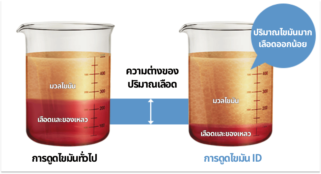 การดูดไขมัน