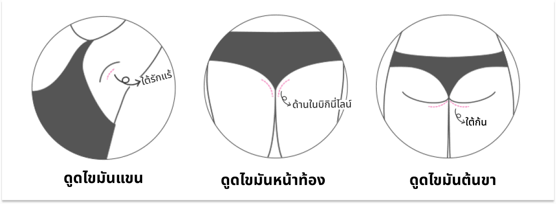 กระบวนการดูดไขมัน