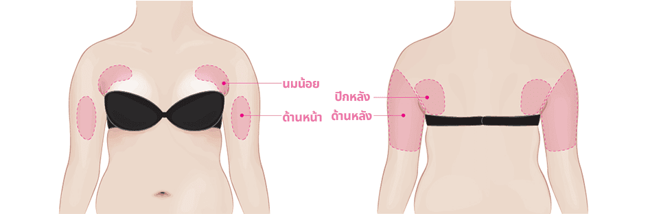 การดูดไขมันบริเวณต้นแขน