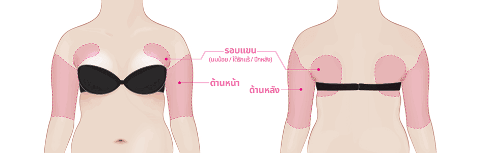 การดูดไขมันบริเวณต้นแขน