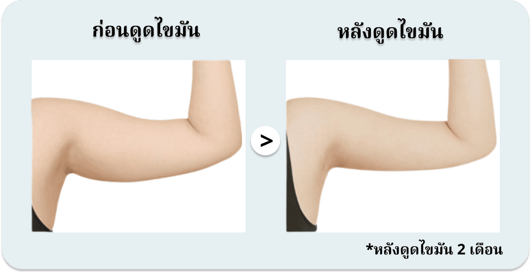การดูดไขมันบริเวณต้นแขน