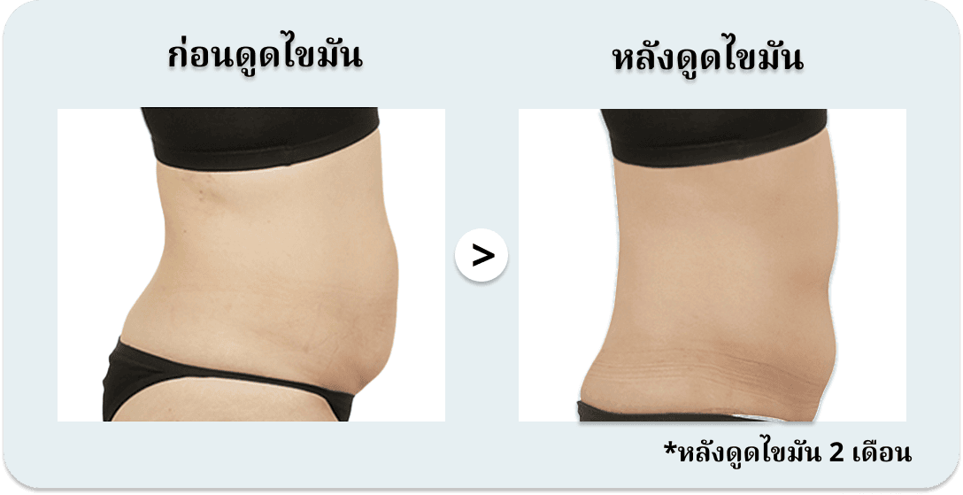 การดูดไขมันบริเวณหน้าท้อง