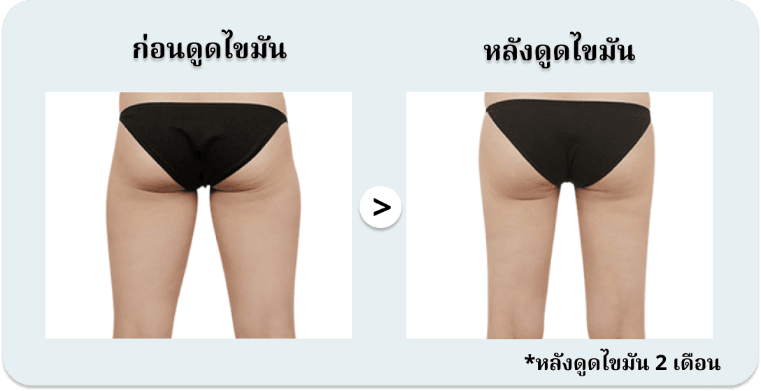 การดูดไขมันบริเวณต้นขา