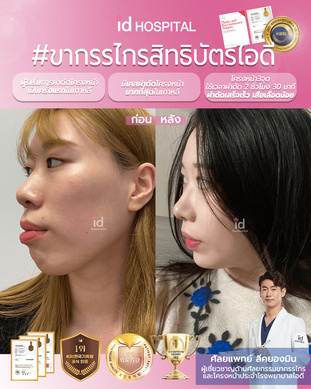 ภาพรีวิวก่อนและหลังศัลยกรรมโครงหน้า เคสที่ 19655