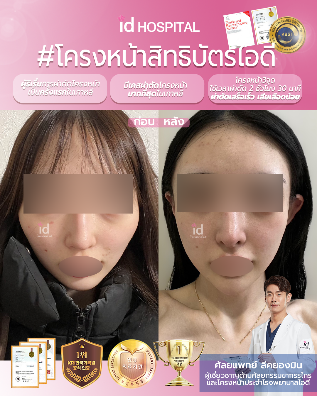ภาพรีวิวก่อนและหลังศัลยกรรมโครงหน้า เคสที่ 19837