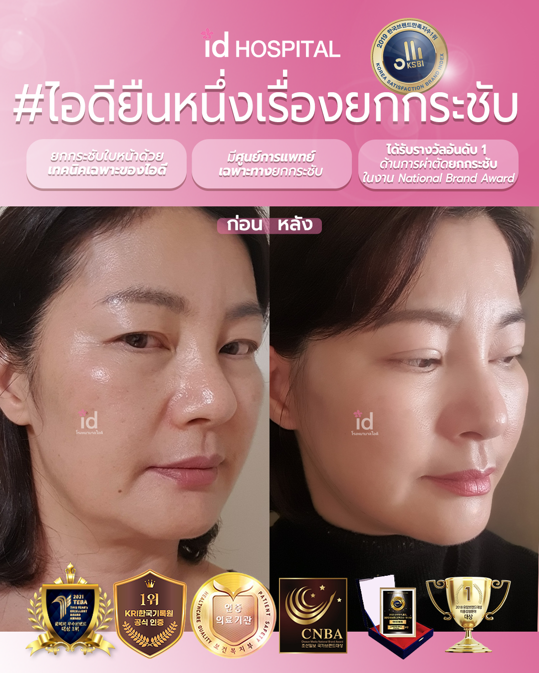 ภาพรีวิวก่อนและหลังตา เคสที่ 19938