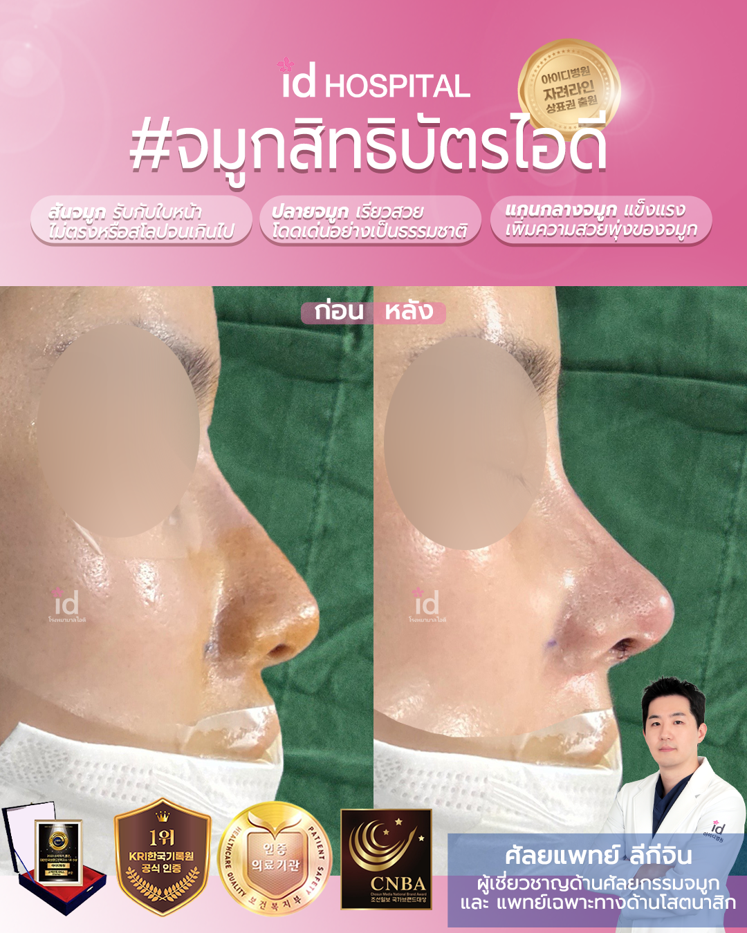 ภาพรีวิวก่อนและหลังจมูก เคสที่ 19862