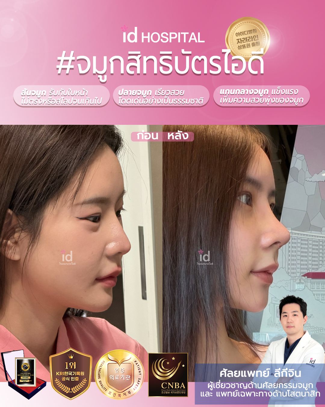 ภาพรีวิวก่อนและหลังจมูก เคสที่ 19913