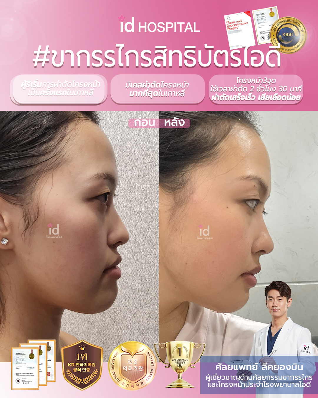 ภาพรีวิวก่อนและหลังศัลยกรรมโครงหน้า เคสที่ 19981