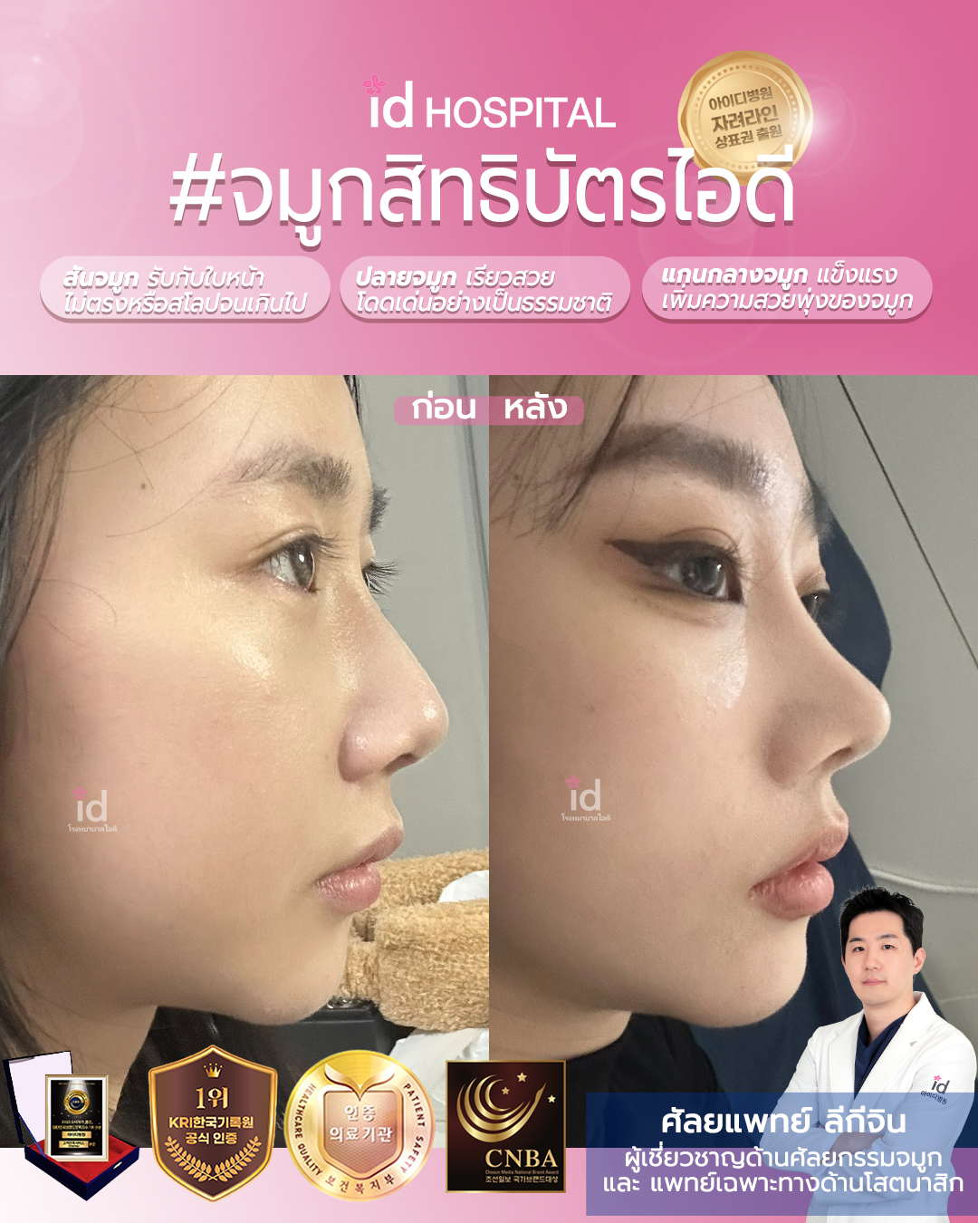 ภาพรีวิวก่อนและหลังจมูก เคสที่ 20019