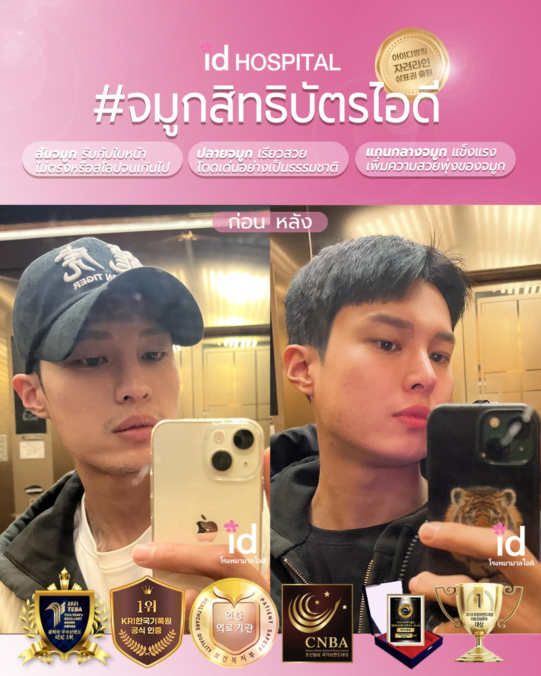 ภาพรีวิวก่อนและหลังจมูก เคสที่ 20103